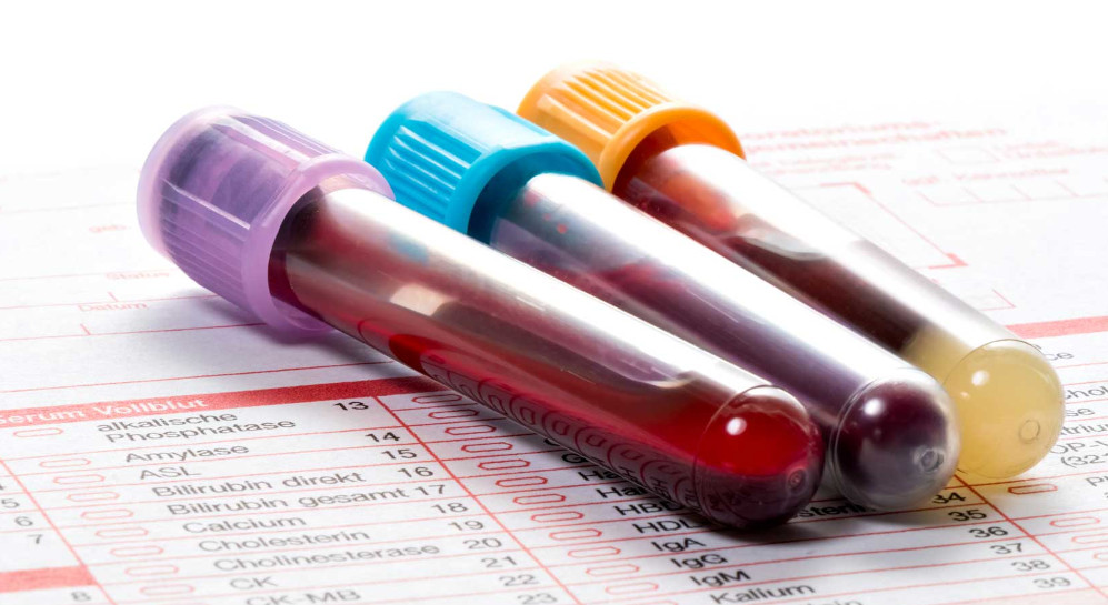 Blood sample tubes on lab report for IgG food sensitivity testing Blood sample tubes on lab report for IgG food sensitivity testing